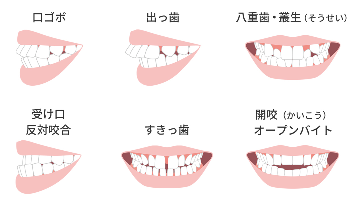 様々な歯並びの症状