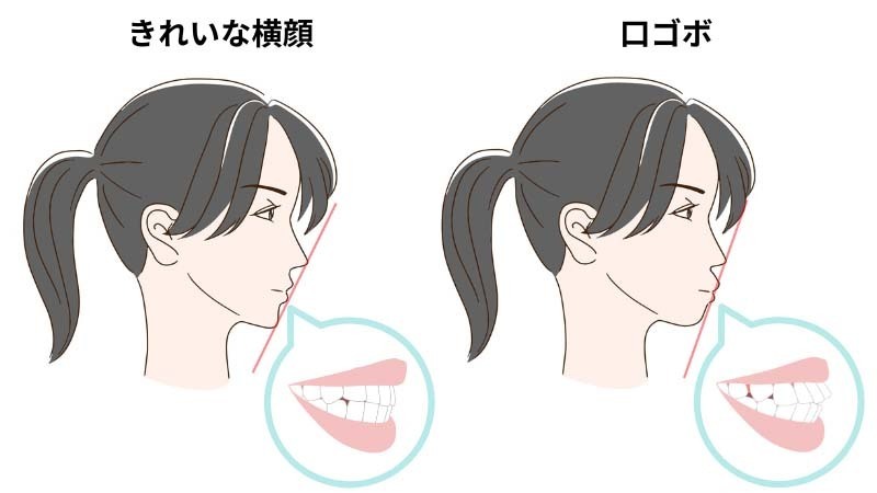 キレイな横顔と口ゴボの横顔の比較