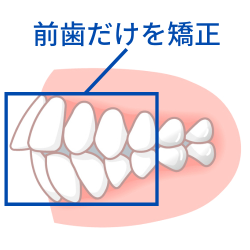 突き出した前歯