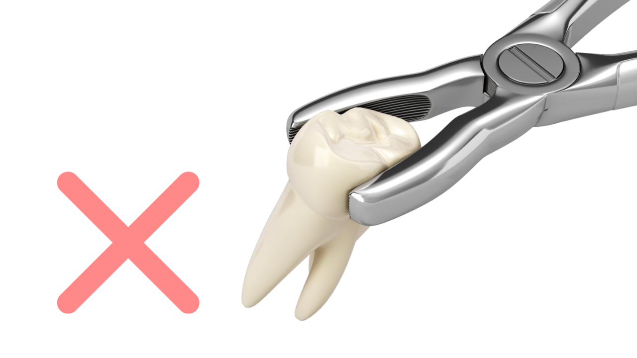 抜歯のイメージ