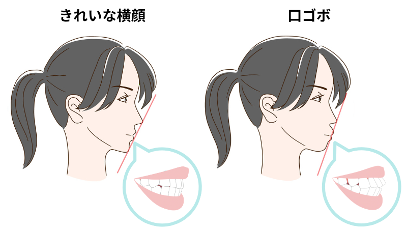キレイな横顔と口ゴボの横顔の比較